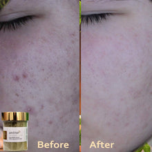 Load image into Gallery viewer, Acne Solution Kit for Face